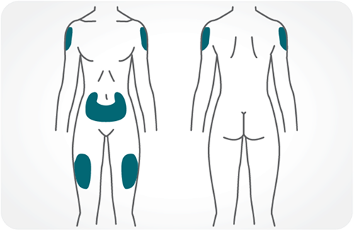 Injection sites labeled on the body